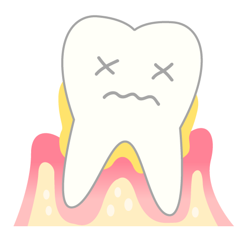 periodontosis_mechanism04.png